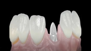 Prothèse implant dentaire